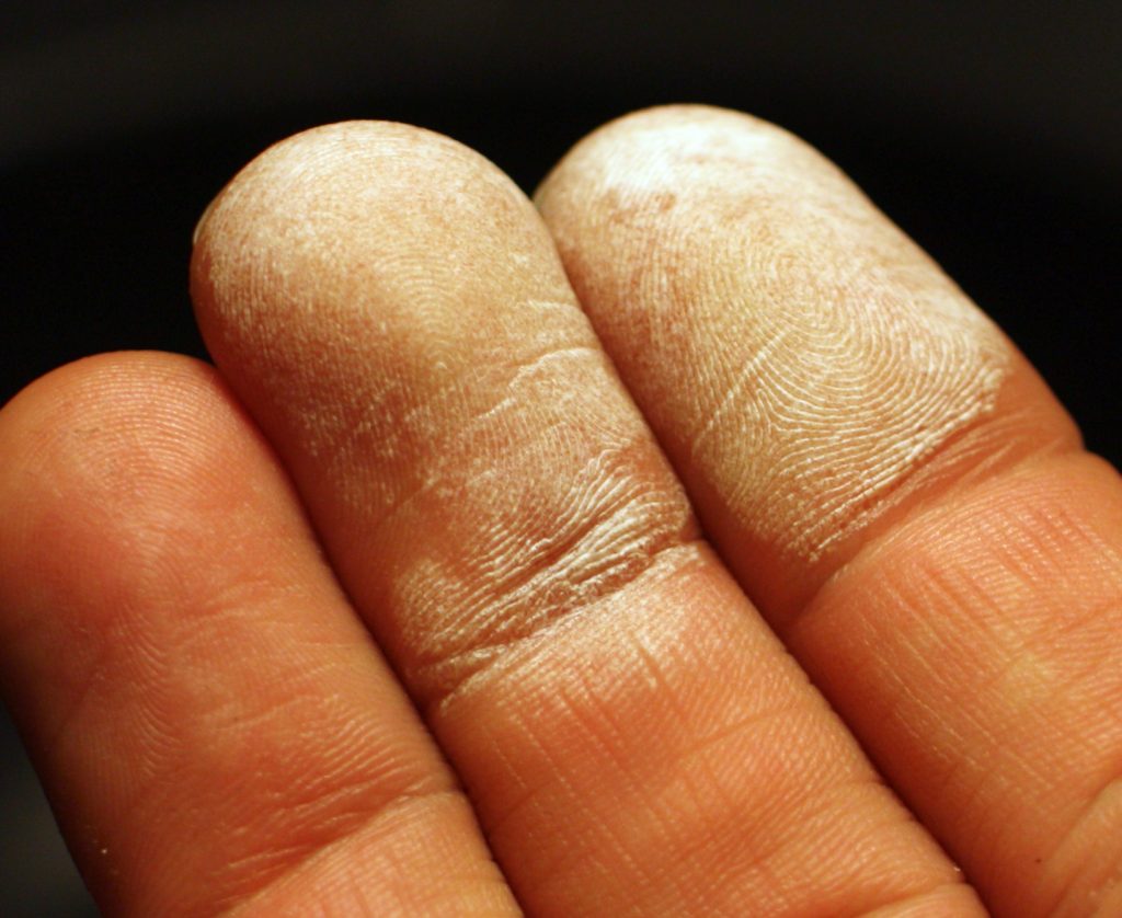 Hydrogen peroxide 35 percent on skin